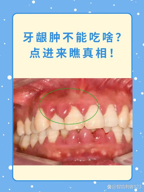 舌根和牙龈被缝一起,舌根和牙龈被缝一起怎么办